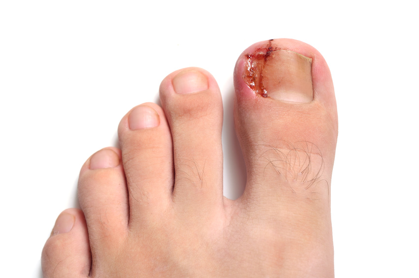 Nail figure, ingrown nail, purulence onychocryptosis Isolated on white.